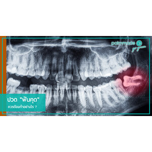 ปวด "ฟันคุด" ควรต้องทำอย่างไร ?