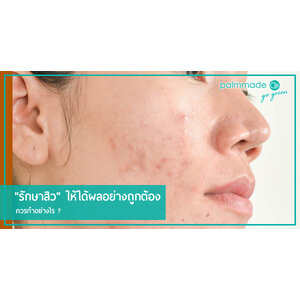 "รักษาสิว" ให้ได้ผลอย่างถูกต้อง ควรทำอย่างไร ?