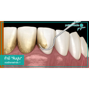 ถ้ามี "หินปูน" ควรรักษาอย่างไร ?