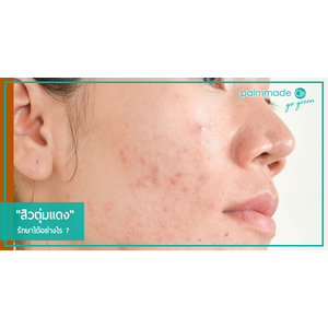 "สิวตุ่มแดง" รักษาได้อย่างไร ?