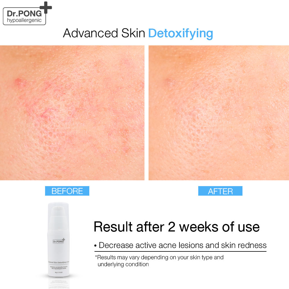 Dr. Pong Advanced Skin Detoxifying Cream - ครีมพักหน้า ครีมบำรุงผิวหน้า ครีมหน้าใส ครีมลดริ้วรอย