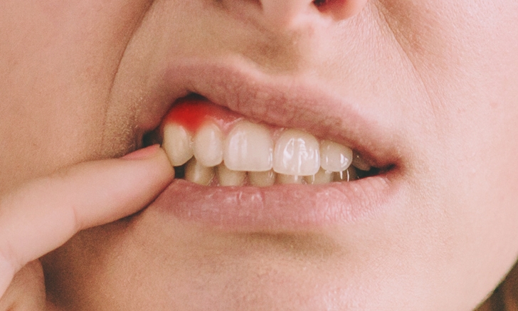 โรคเหงือกอักเสบ" เป็นอย่างไร อันตรายขนาดไหน ? - Palmmade Industry(Thailand) Co.,Ltd : Inspired by LnwShop.com