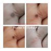 รีวิว กำจัดหูด ง่ายๆด้วย ครีมกำจัดไฝ ขี้แมลงวัน กระ ติ่งเนื้อ by lilyshop43 (ผลลัพธ์ขึ้นอยู่กับสภาพผิวส่วนบุคคล)