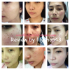 รีวิว กำจัดกระ ง่ายๆด้วยตนเอง โดย ครีมกำจัดไฝ ขี้แมลงวัน กระ ติ่งเนื้อ by lilyshop43 (ผลลัพธ์ขึ้นอยู่กับสภาพผิวส่วนบุคคล)