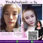 ฉีดไขมันตัวเอง ลดริ้วรอย เพิ่มความอ่อนเยาว์ให้กับใบหน้า