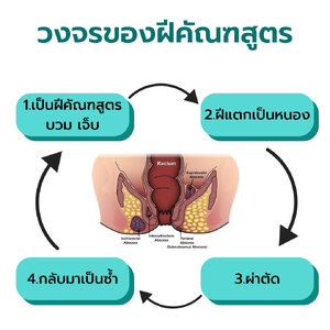 วิธีรักษาฝีคัณฑสูตร ด้วยสมุนไพรธรรมชาติ ปลอดภัย ไม่กลับมาเป็นซ้ำ